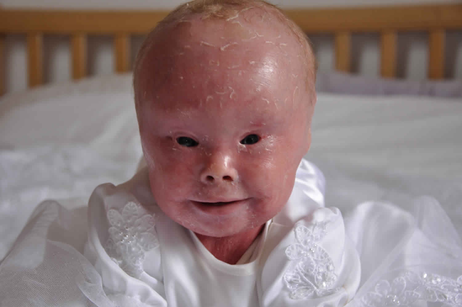 Điều cần biết về bệnh Harlequin ichthyosis ảnh 2 Dieu can biet ve benh Harlequin ichthyosis anh 2