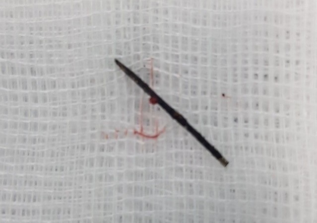 Kim khau gi den trong co the be gai 3 tuoi hinh anh