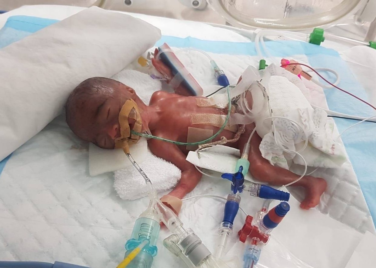 Be gai sinh non chi nang hon 300 g o Singapore hinh anh