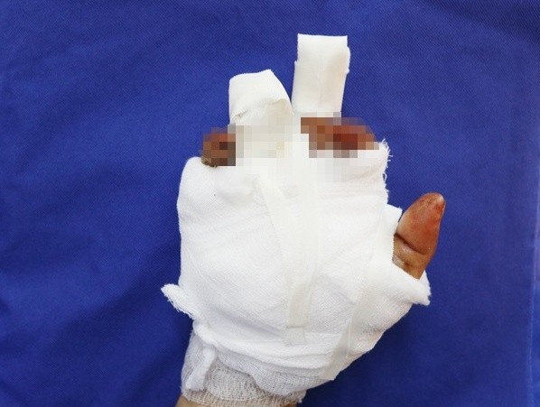 Nguoi phu nu bi dap nat ban tay khi thu gom sat vun hinh anh