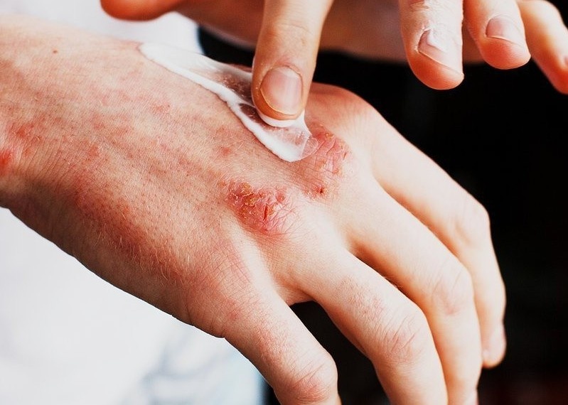 Nhung lam tuong ve benh eczema hinh anh