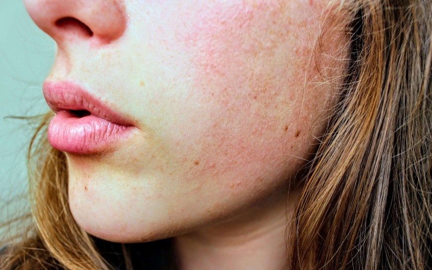 Quan niệm sai lầm về bệnh eczema ảnh 1 Quan niem sai lam ve benh eczema anh 1
