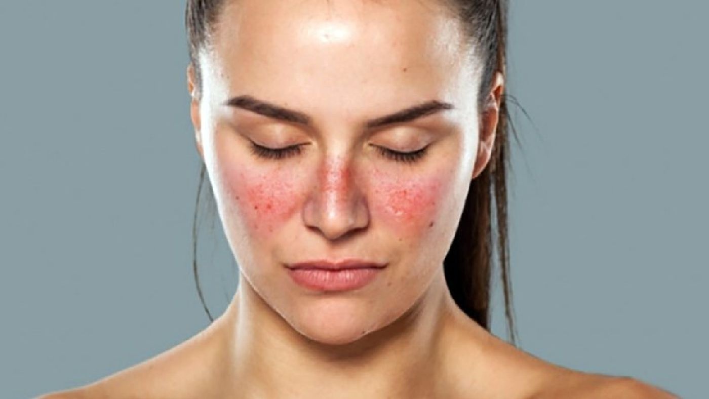 Phân biệt lupus ban đỏ và vảy nến ảnh 1 Phan biet lupus ban do va vay nen anh 1