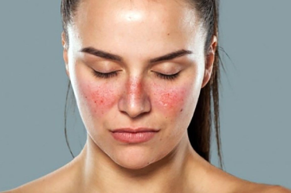 Lupus ban do va vay nen khac nhau nhu the nao? hinh anh