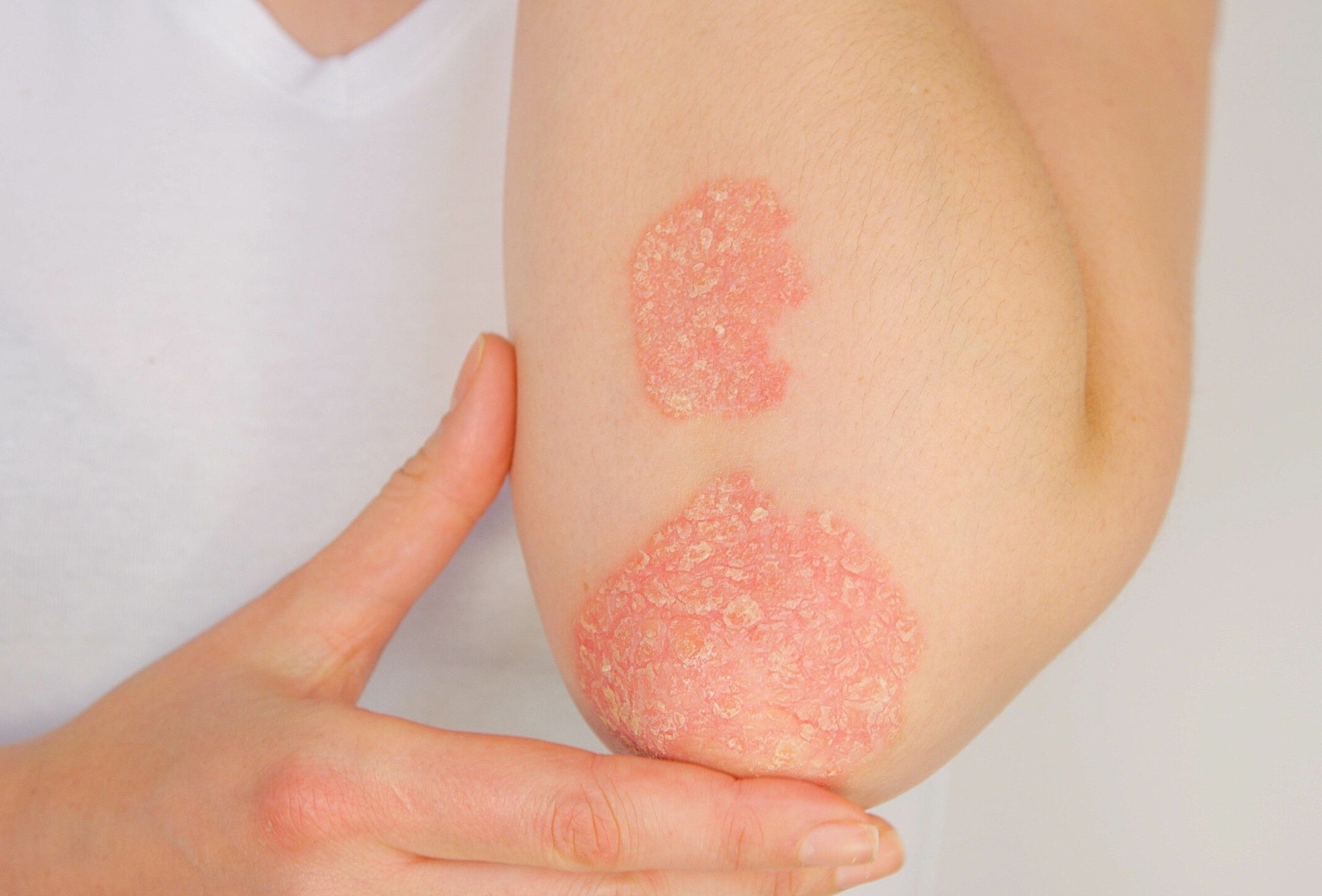 Phân biệt lupus ban đỏ và vảy nến ảnh 2 Phan biet lupus ban do va vay nen anh 2