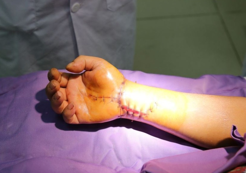 Gan dut roi ban tay do tai nan may cua anh 1