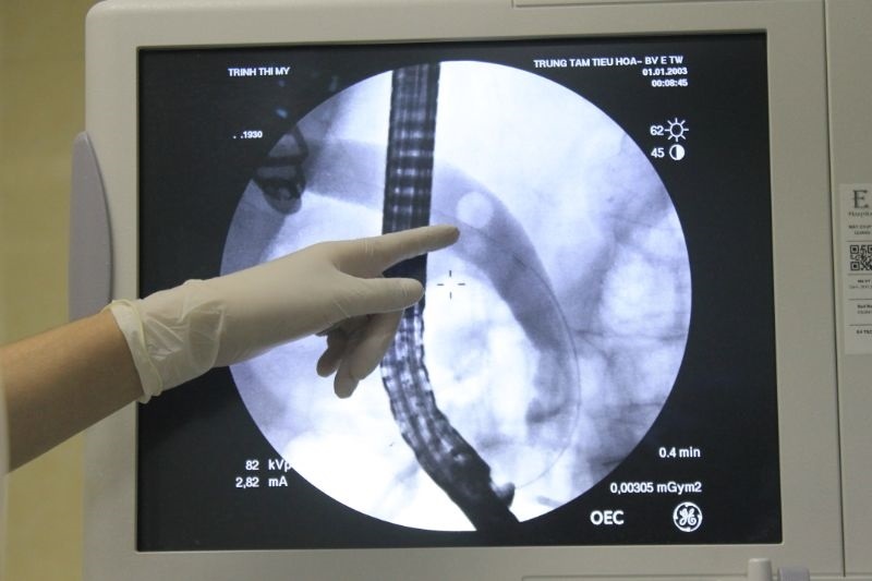 Bệnh nhân 91 tuổi bị nhiễm trùng đường mật ảnh 1 Benh nhan 91 tuoi bi nhiem trung duong mat anh 1