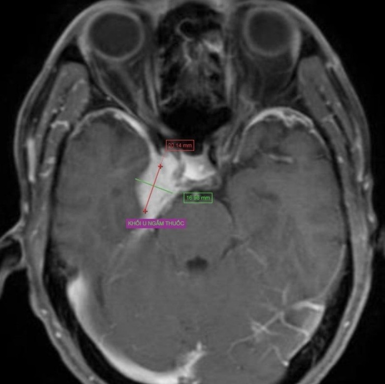 Phat hien u mang nao sau khi ngat xiu anh 1