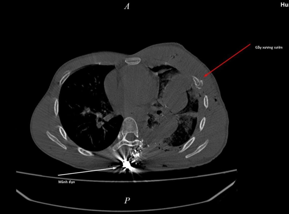 Bi dan ban do giam phai bay sung anh 1