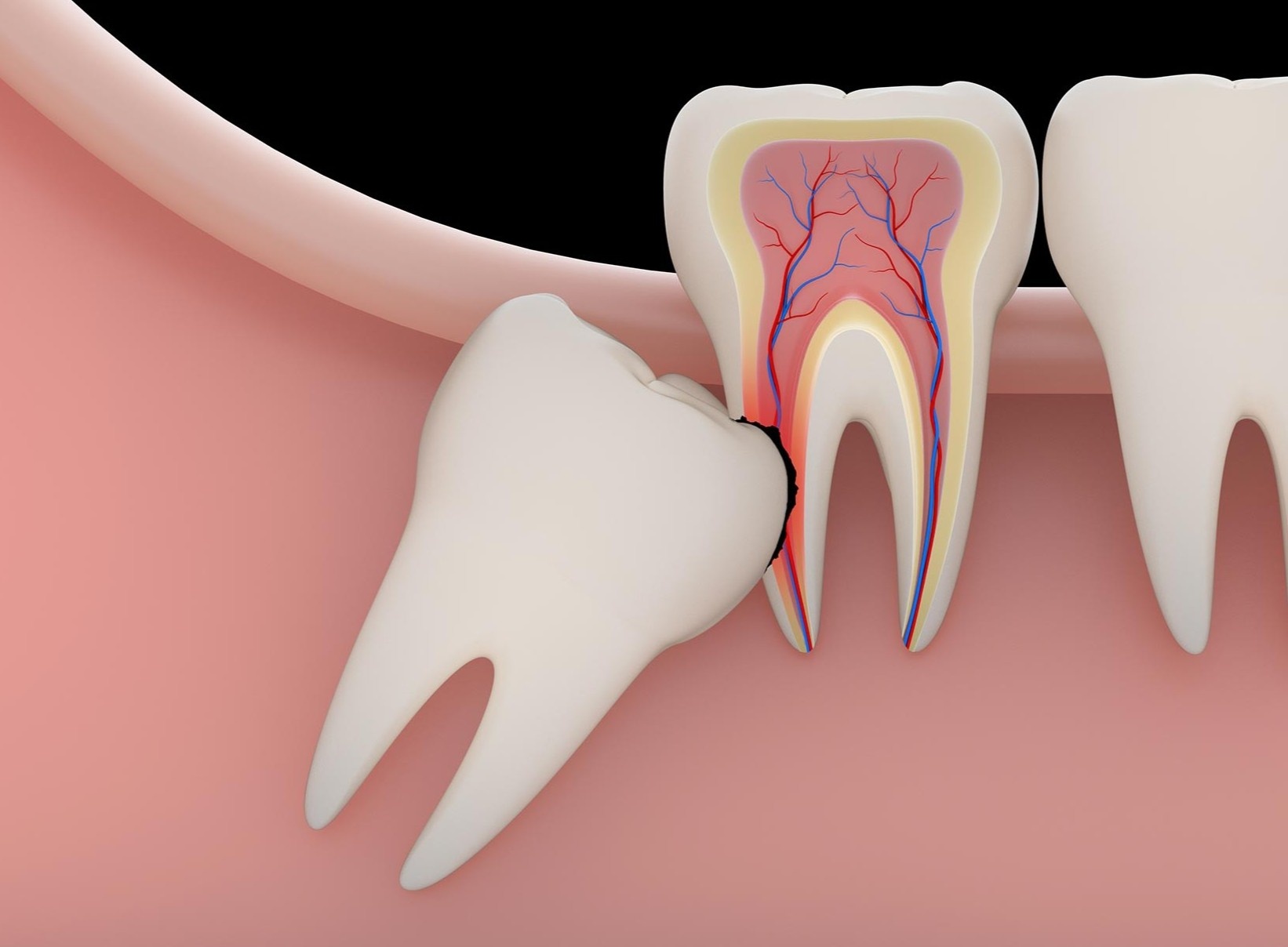 Luu y khi nho rang khon anh 1