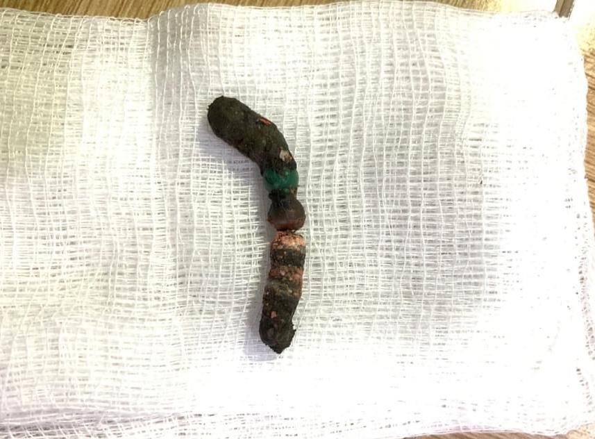 Be gai bi thung ruot do nuot 7 vien bi nam cham hinh anh