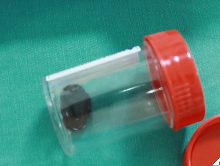 Vắt sống trong khí quản bệnh nhân ảnh 1 Vat song trong khi quan benh nhan anh 1