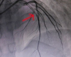 Nguoi tre tuoi bi nhoi mau co tim anh 1