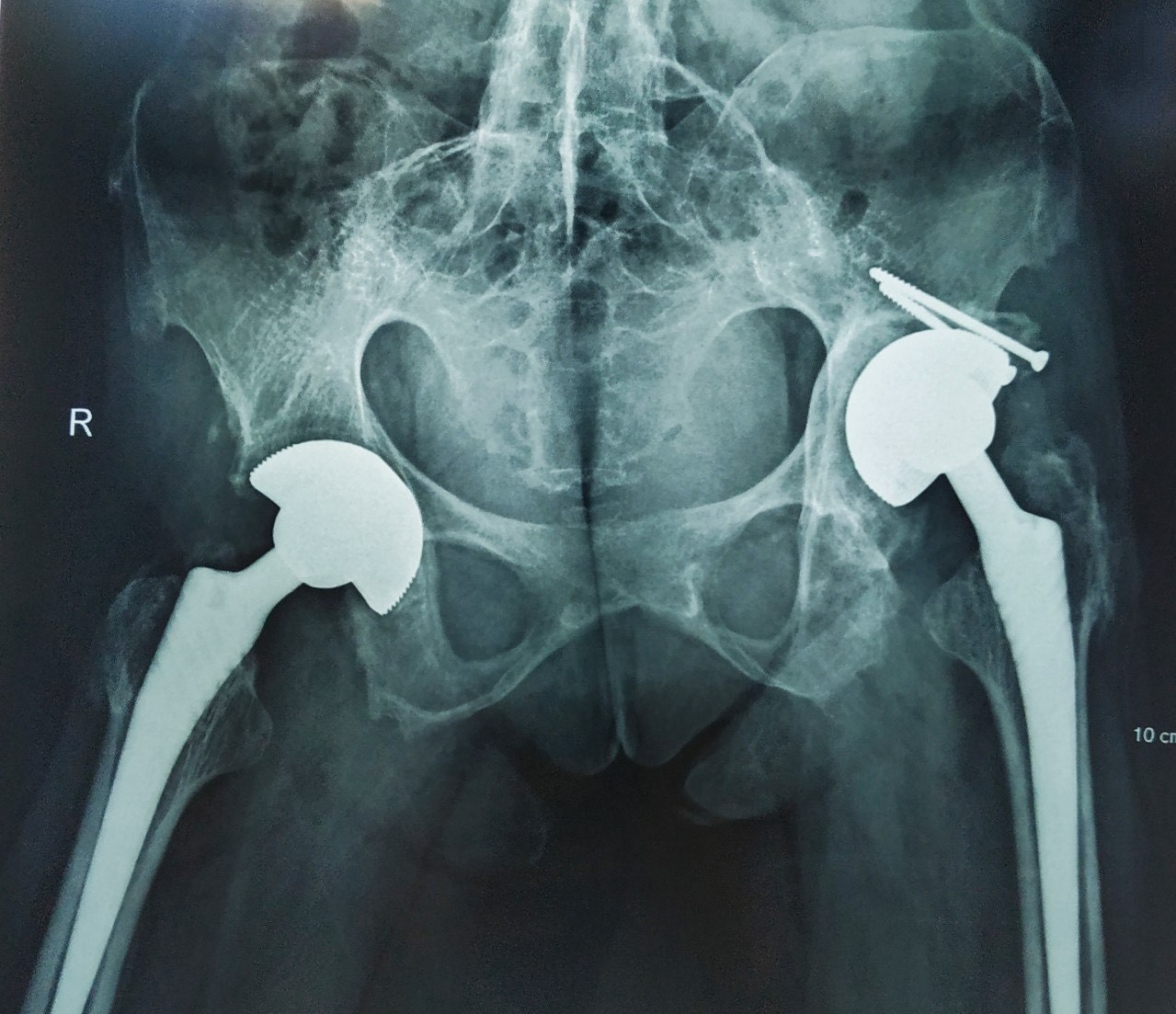 Nguoi phu nu bi viem cot song dinh khop anh 1