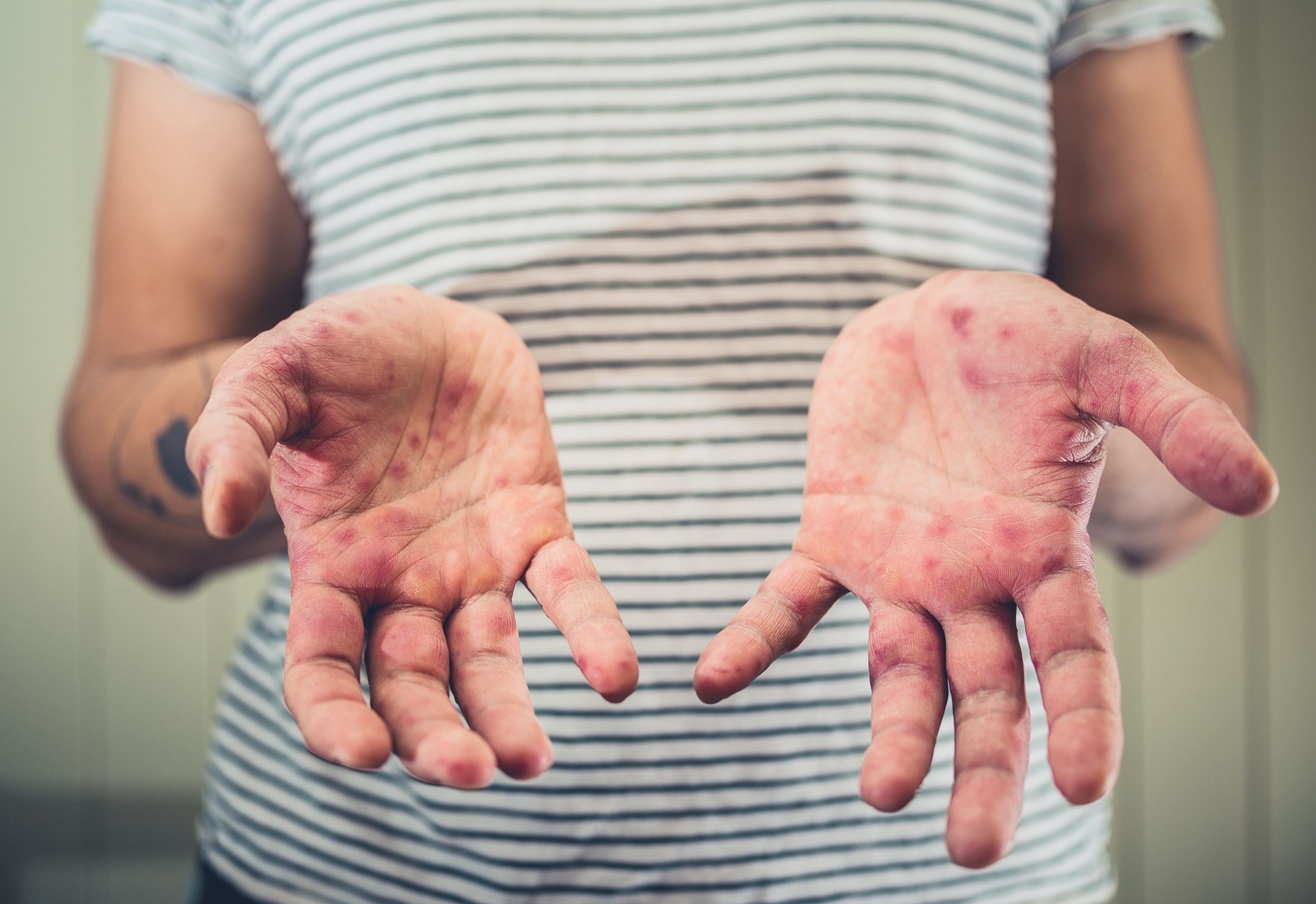 Nguoi lon co the mac benh tay chan mieng khong? hinh anh