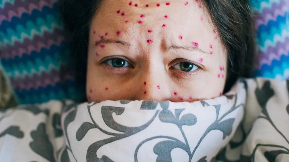 Cach phan biet benh thuy dau va zona than kinh hinh anh