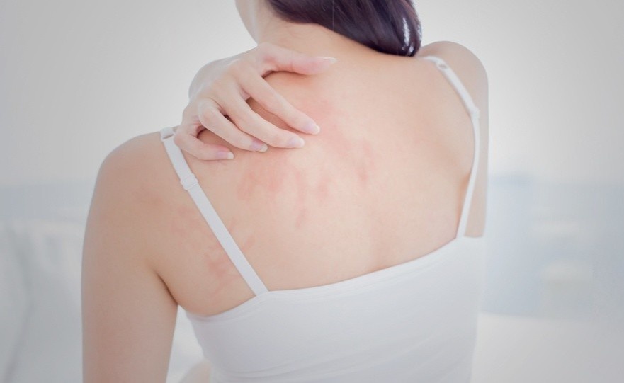 Dau hieu canh bao ban bi phat ban do nhiet hinh anh