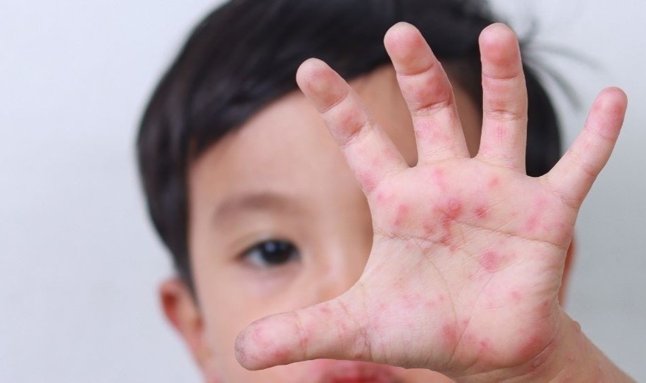 Bien chung can chu y khi mac tay chan mieng hinh anh