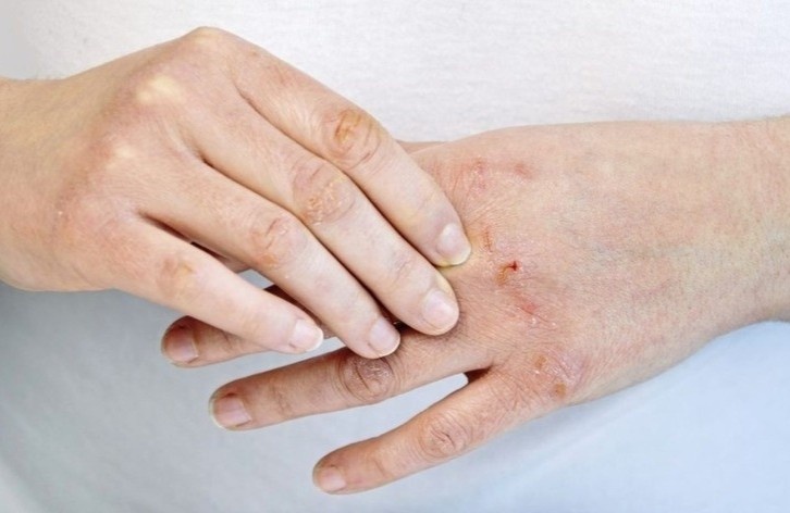 Bien chung pho bien nhat cua benh gioi leo hinh anh