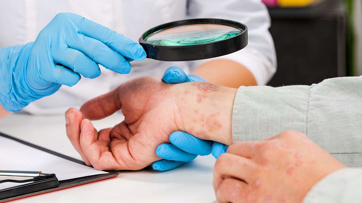 Bien chung cua benh viem da co dia hinh anh