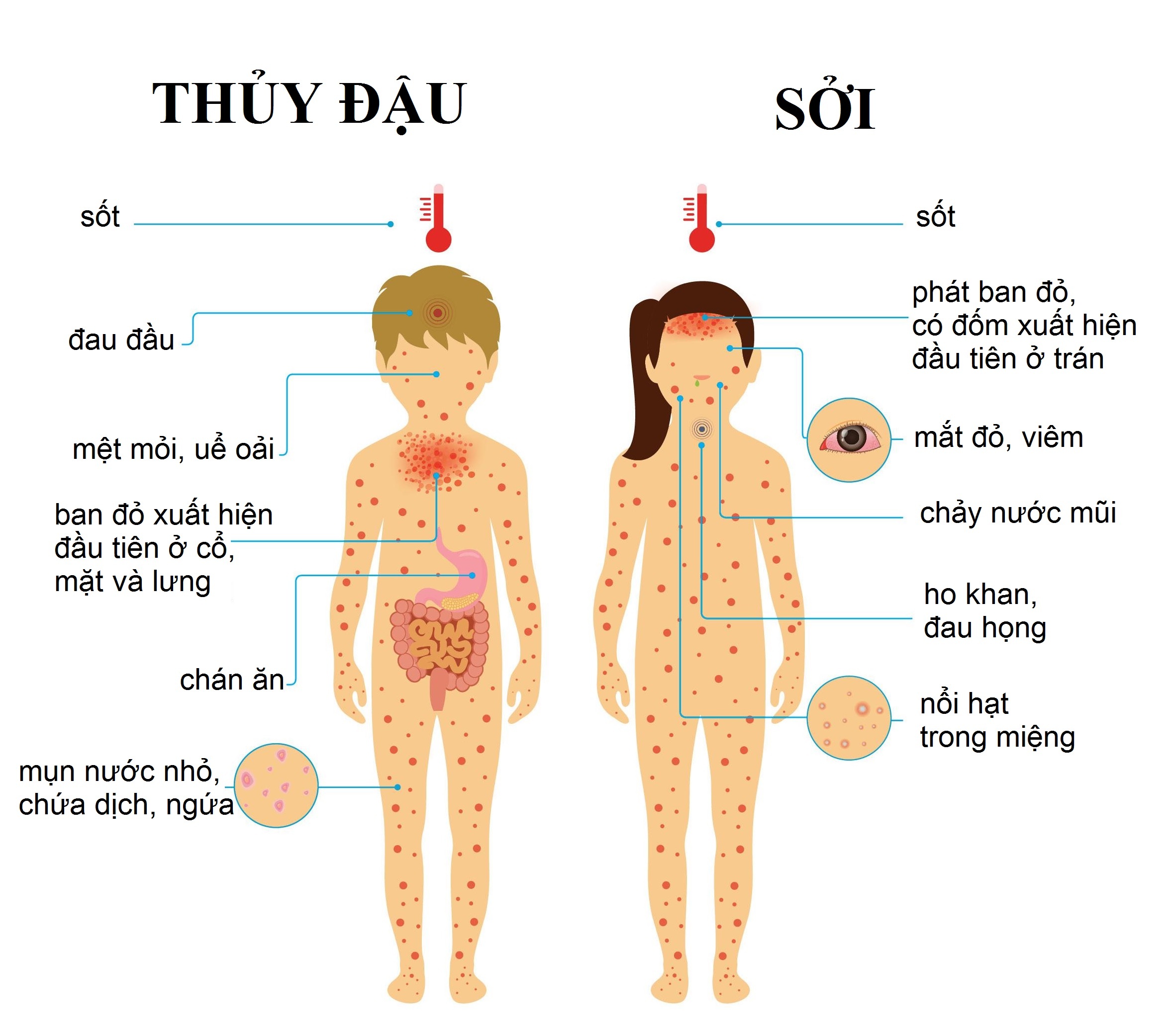 Sởi và thủy đậu ảnh 1 Soi va thuy dau anh 1