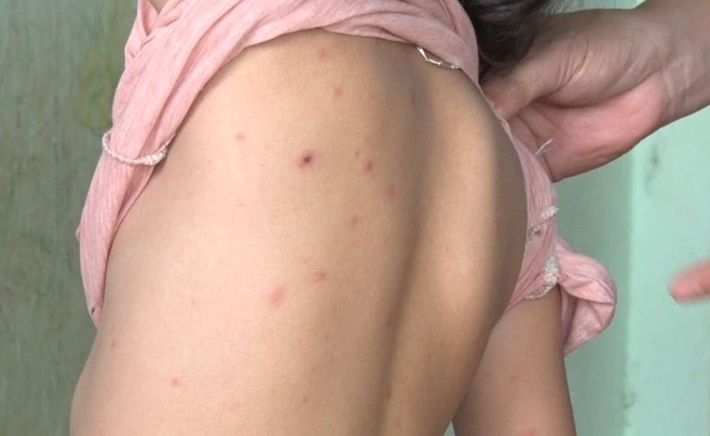 Nhieu o dich thuy dau bung phat o Dak Lak hinh anh