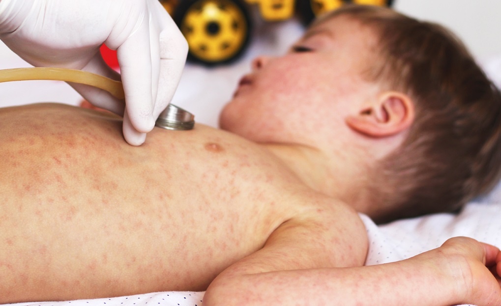 Dau hieu cua benh soi hinh anh