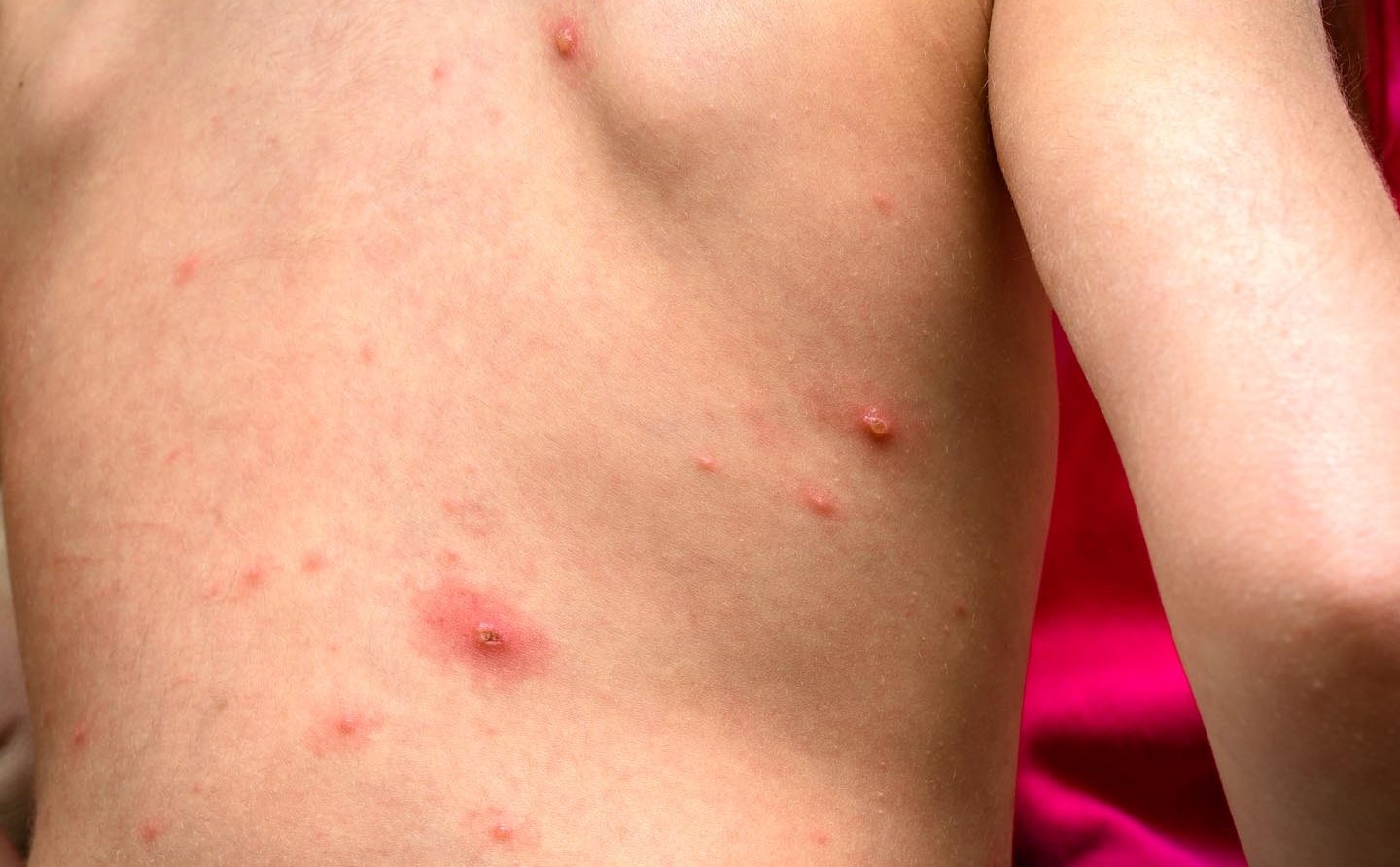 Benh nhan soi co the lay cho bao nhieu nguoi? hinh anh