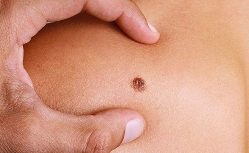 Nhung vet den la xuat hien canh bao nguy co ung thu hinh anh