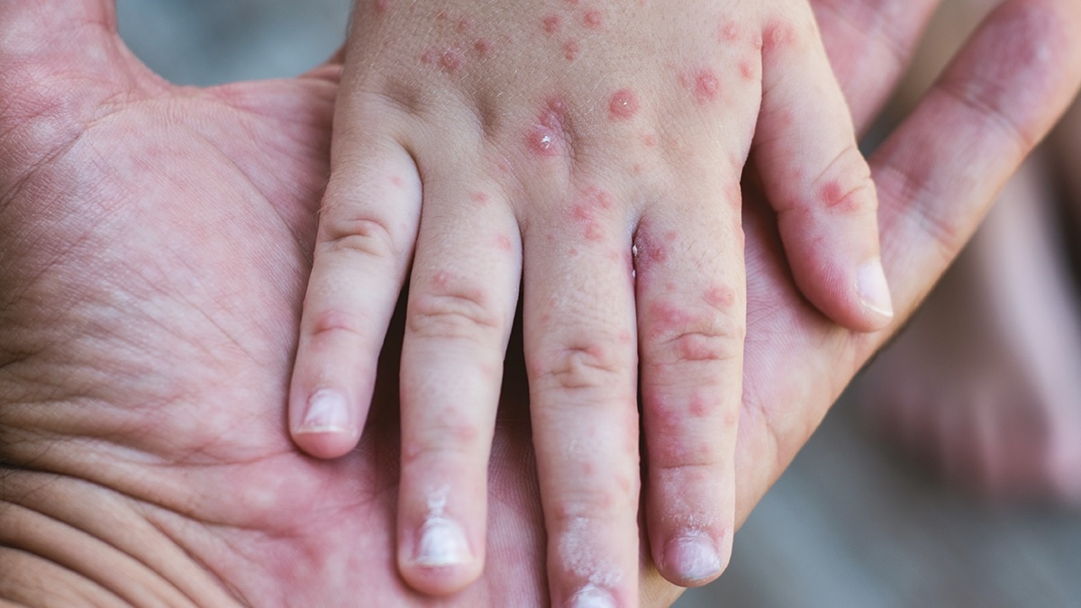 Thoi diem virus soi de lay lan nhat hinh anh