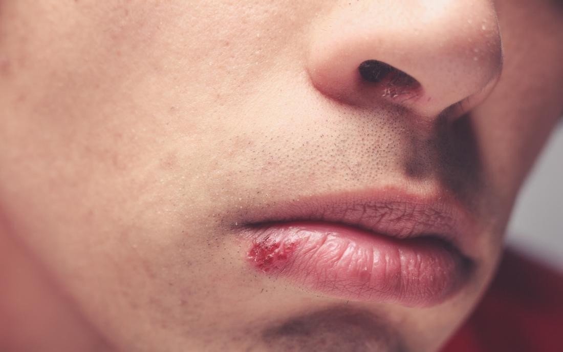 Nhung trieu chung som cua benh giang mai hinh anh