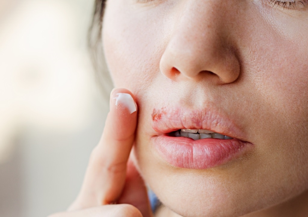 Dau hieu ban da nhiem Herpes sinh duc hinh anh