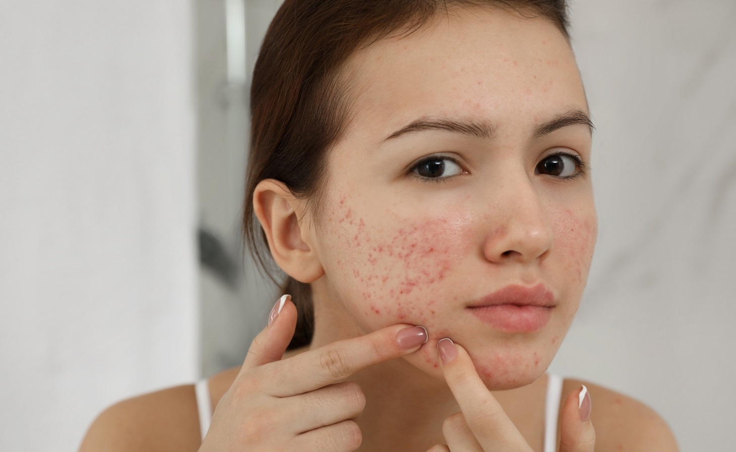 4 thay doi nho giup ngan ngua mun trung ca hinh anh