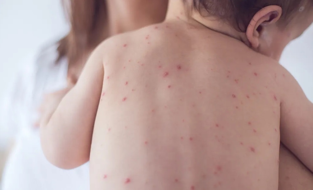 Hai loai thuoc khong nen cho tre uong khi bi thuy dau hinh anh