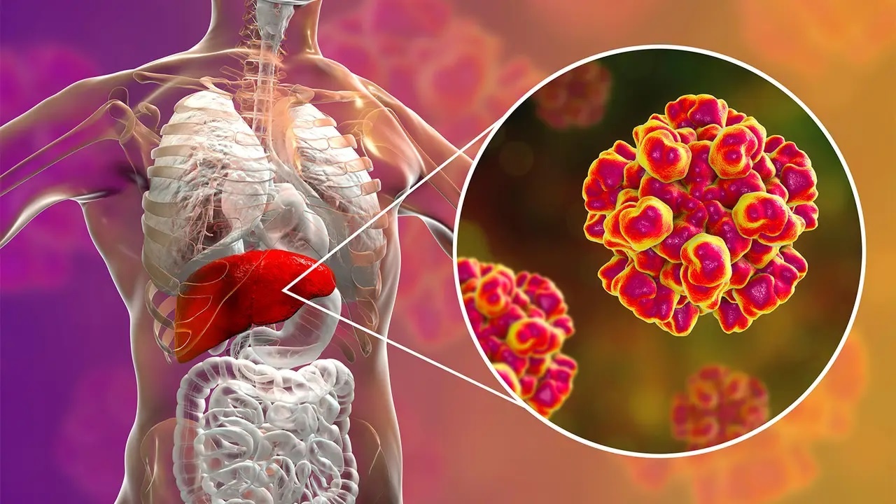 Viem gan E la benh gi? hinh anh