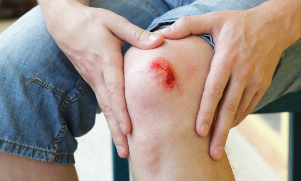 6 buoc cham soc vet thuong ho mau lanh hinh anh