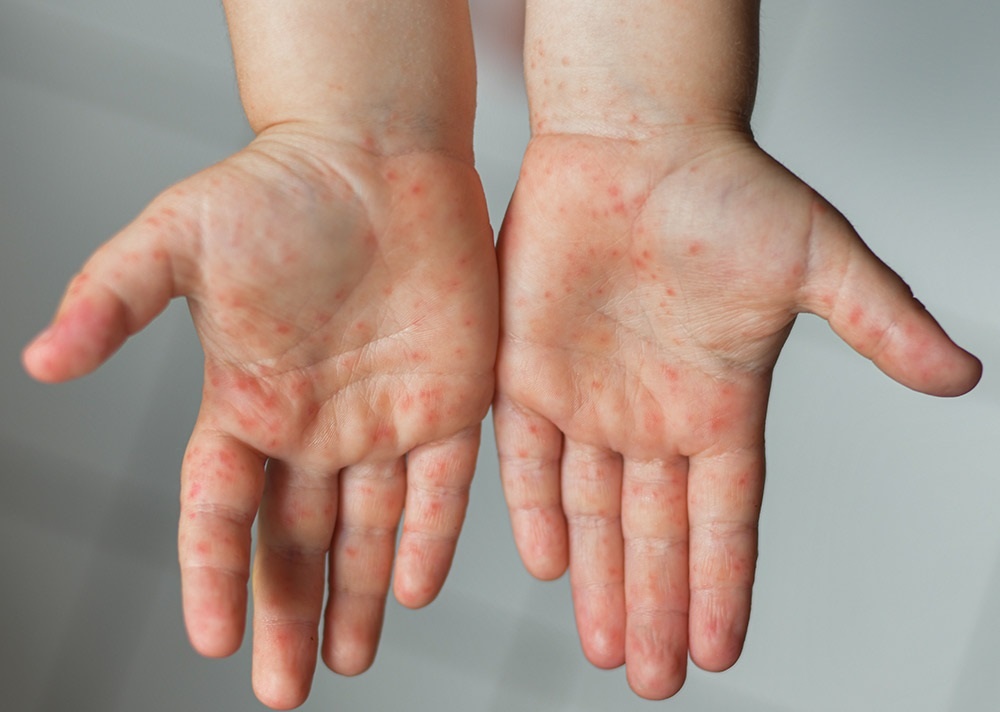 Bieu hien tro nang khi tre mac tay chan mieng hinh anh