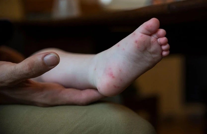 Thoi diem lay nhiem cao nhat cua benh tay chan mieng hinh anh