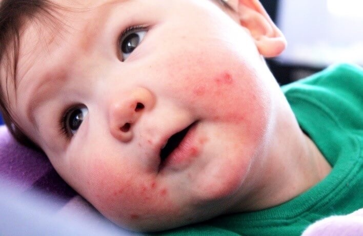 Dieu can chu y khi cham soc tre bi tay chan mieng hinh anh