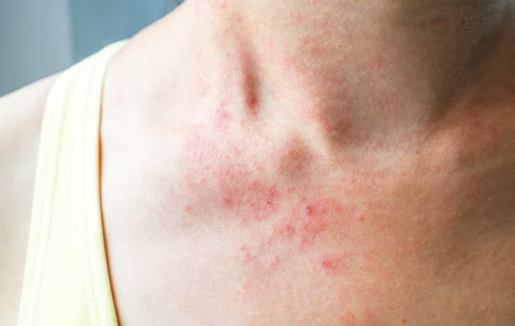 Nhan dien not phat ban nguy hiem hinh anh