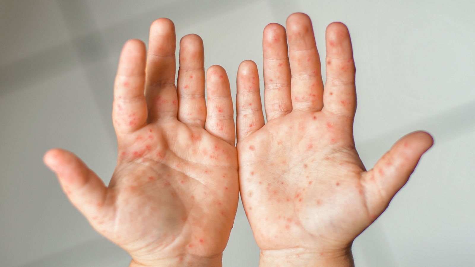 Trieu chung benh tay chan mieng theo tung giai doan hinh anh