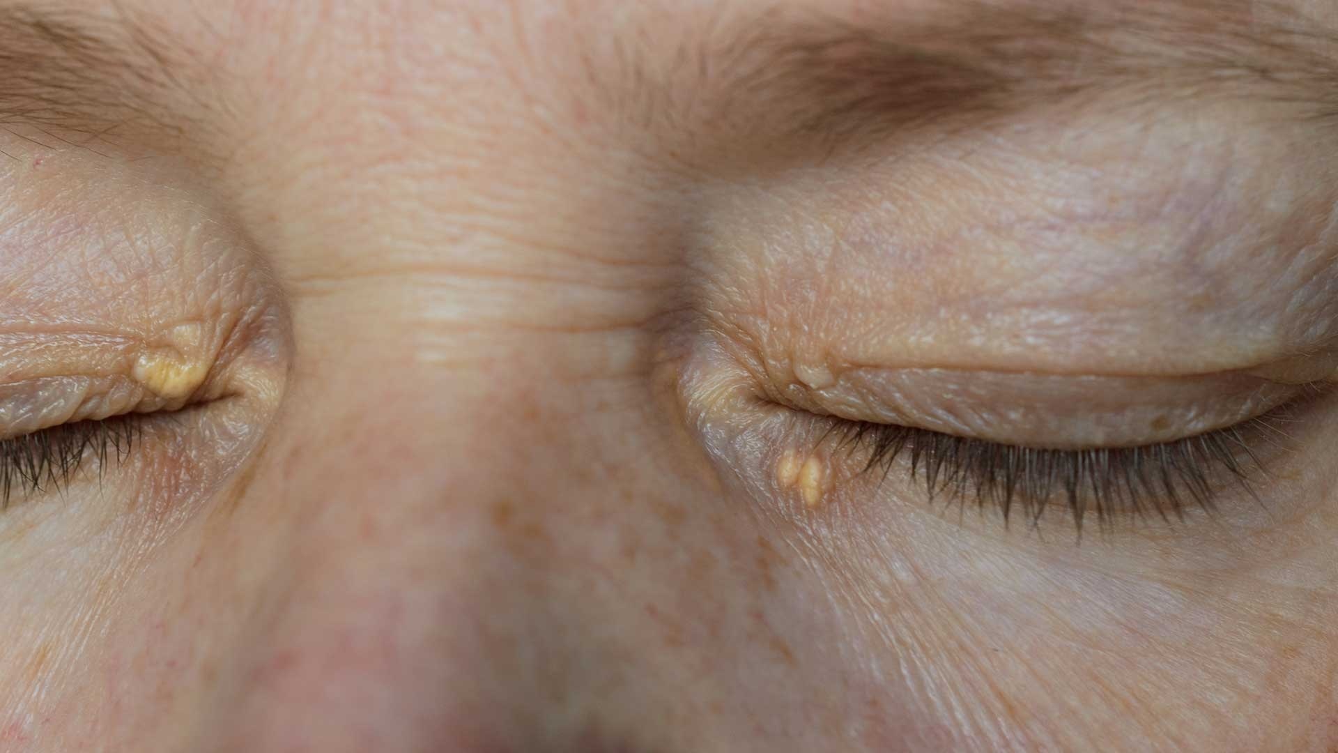 Dau hieu khang insulin anh 2