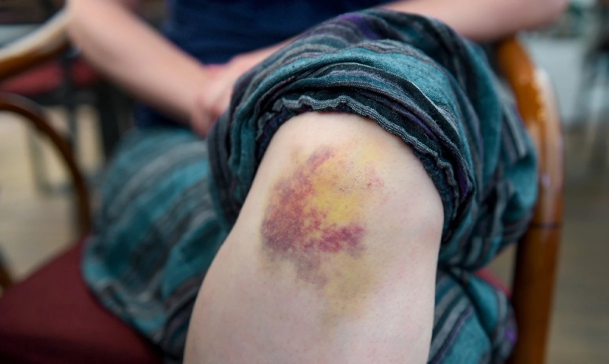 Dau hieu khang insulin anh 7