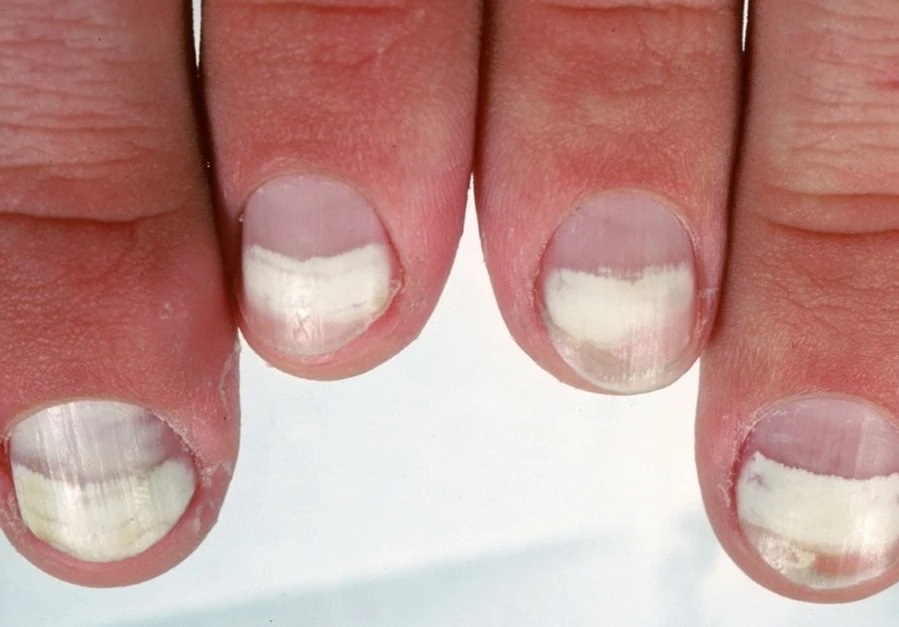 Dấu hiệu suy thận ảnh 2 Dau hieu suy than anh 2