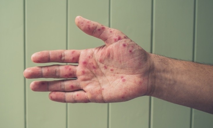 Loai virus dang lan 'vuot ngoai tam kiem soat', khong co thuoc dac tri hinh anh