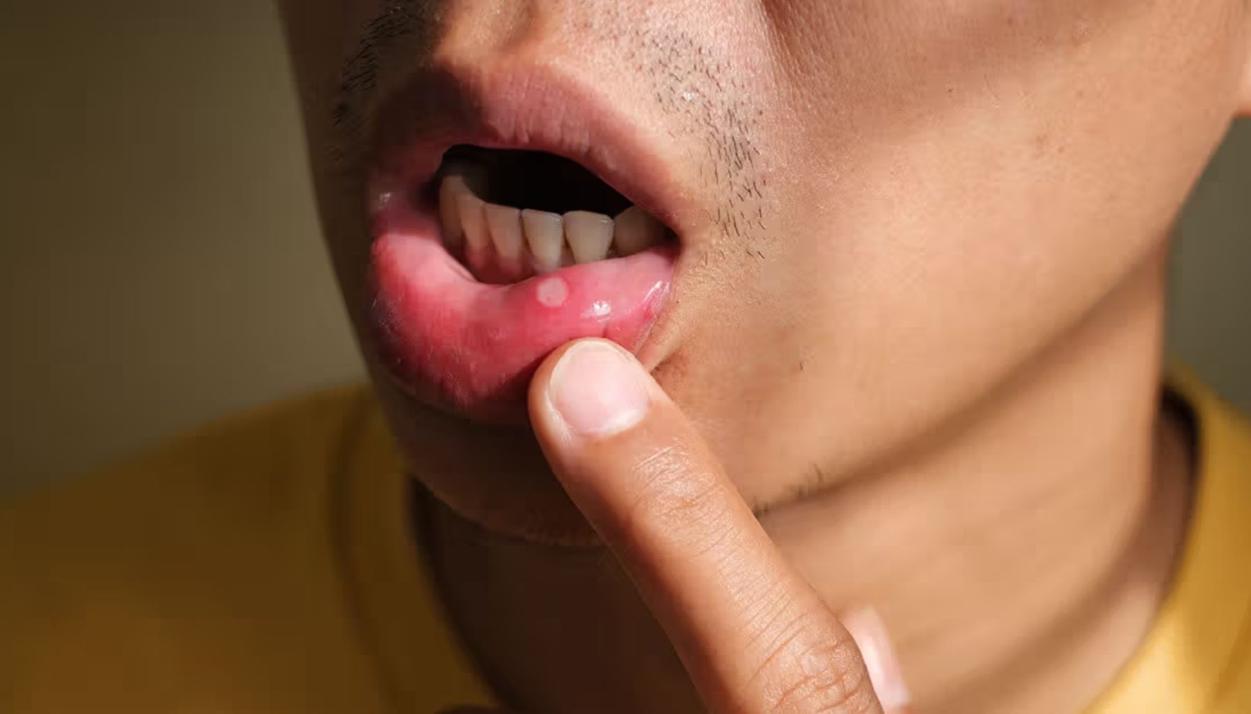 Nhung trieu chung canh bao ung thu o nam gioi giai doan dau hinh anh