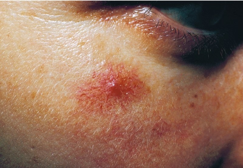 Dau hieu benh gan anh 7