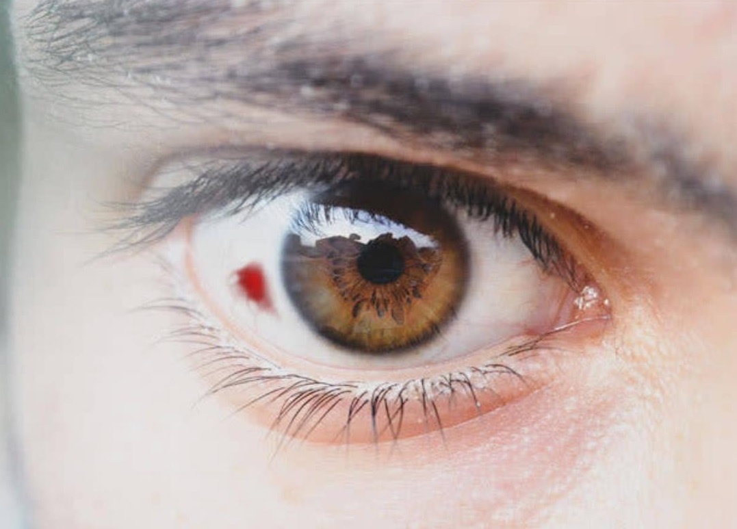 Dau hieu huyet ap cao anh 1