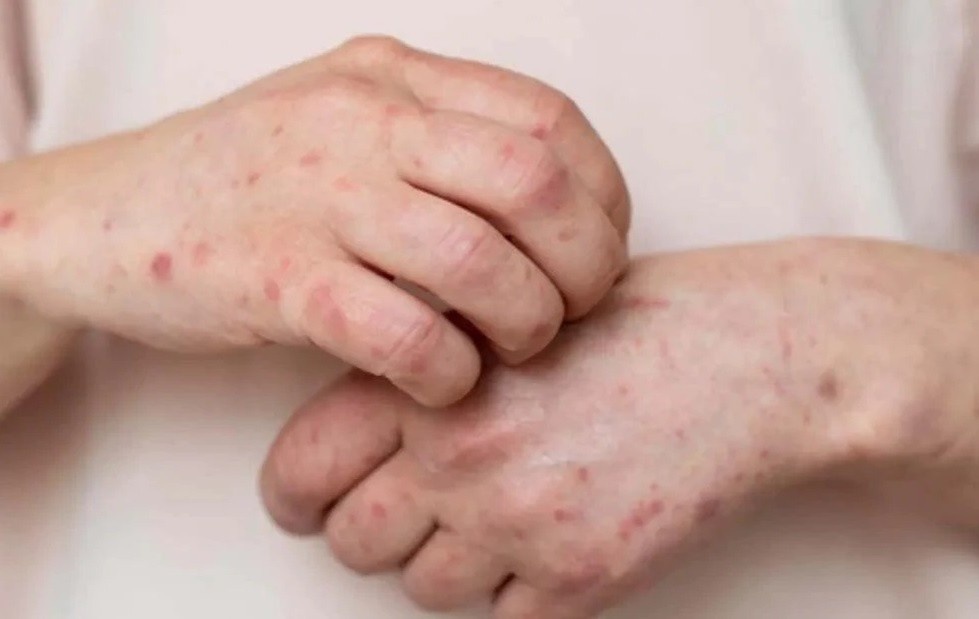 Dau hieu canh bao ung thu dai trang xuat hien tren da hinh anh