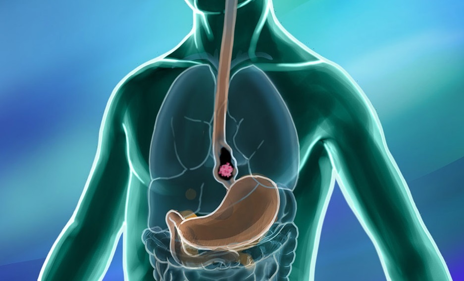 4 dau hieu som canh bao ung thu thuc quan hinh anh